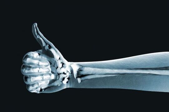 X-ray used to diagnose pain in the finger joints