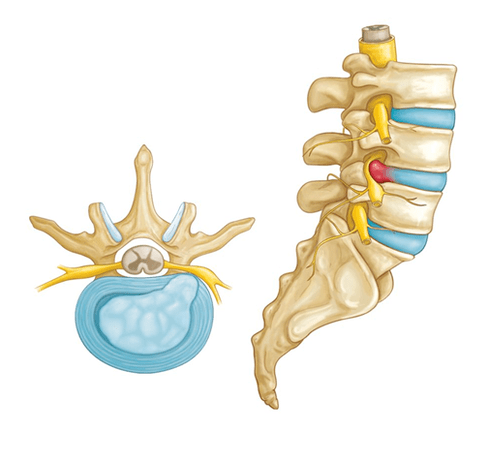 Back pain from a herniated disc