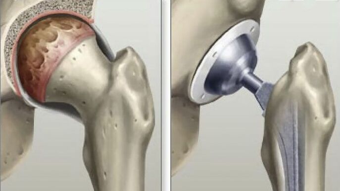 Hip replacement in the final stage of coxarthrosis