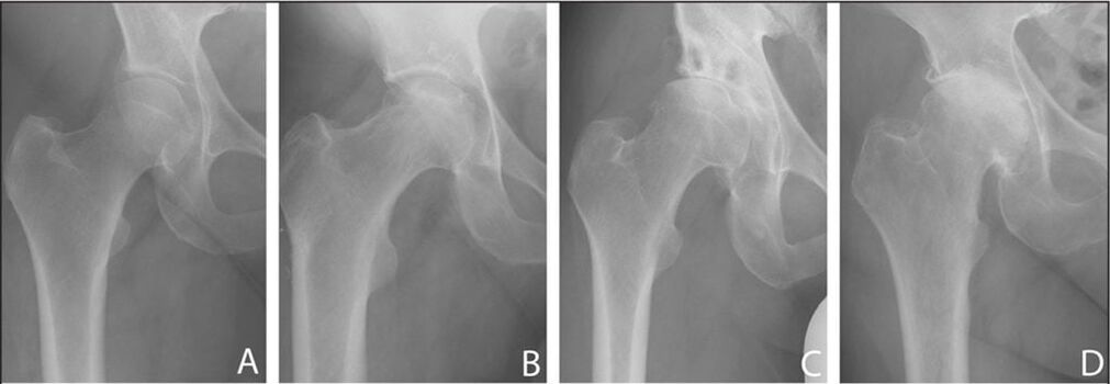 Stages of development of osteoarthritis of the hip joint on x-rays