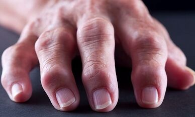 What is the difference between arthritis due to arthrosis