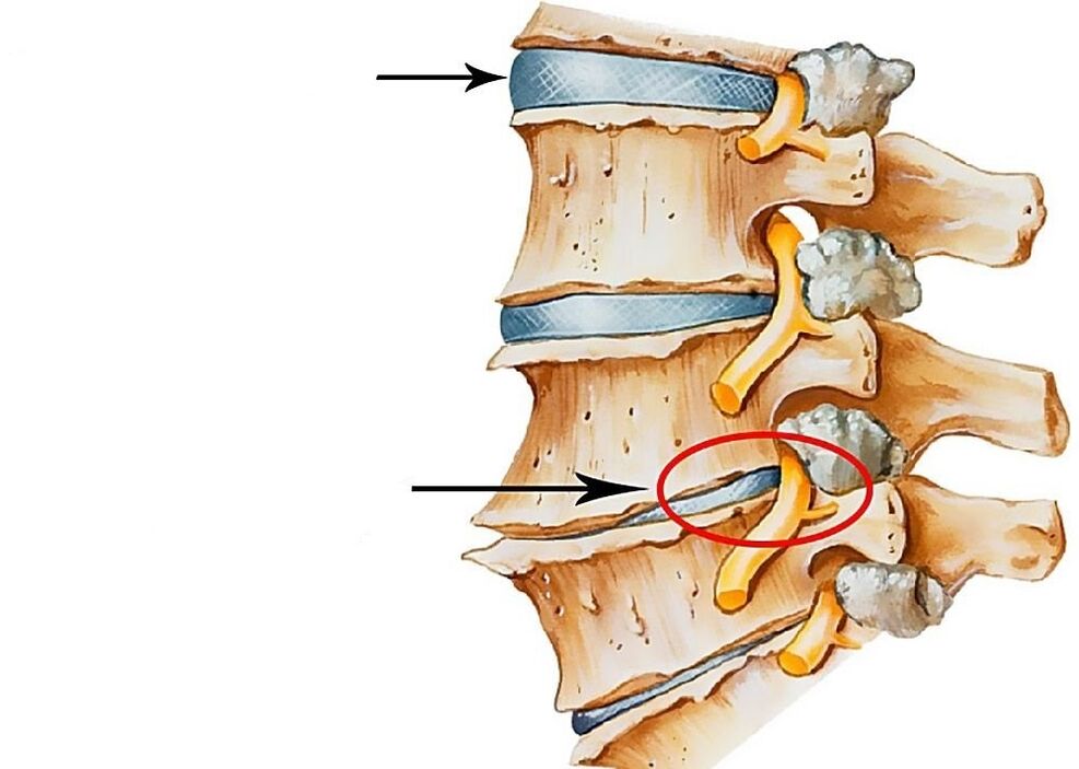 Representation of healthy and deformed intervertebral discs