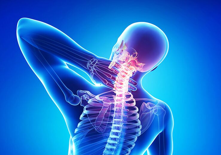 Spinal osteochondrosis is a disease that affects articular cartilage and vertebrae.