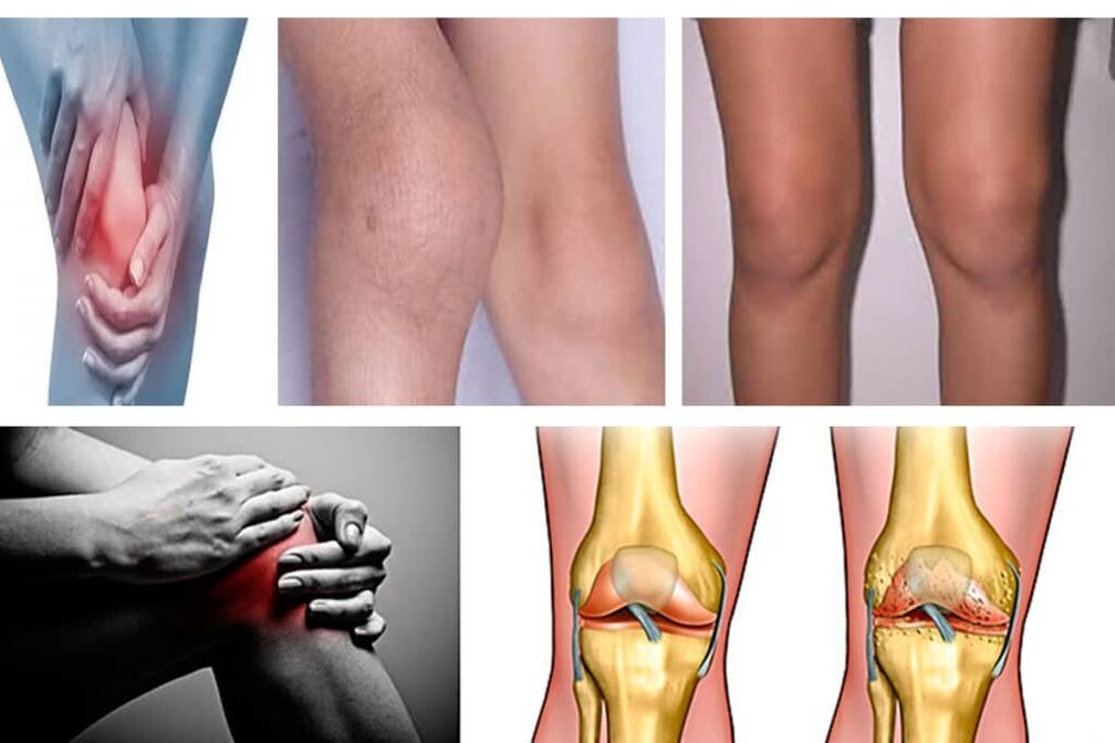 Osteoarthritis, what is it