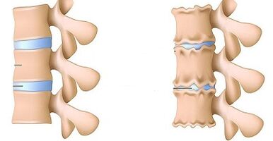 How to recognize the presence of osteochondrosis of the lumbar spine