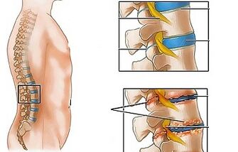 The causes of osteochondrosis of the lumbar spine