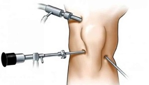 Arthroscopy for osteoarthritis of the knee joint