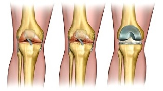 Endoprosthetics for osteoarthritis of the knee joint